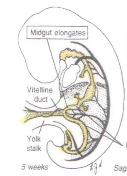 Meckel s Embryology Patent Duct Remnant of omphalomesenteric (vitelline) duct Complete obliteration
