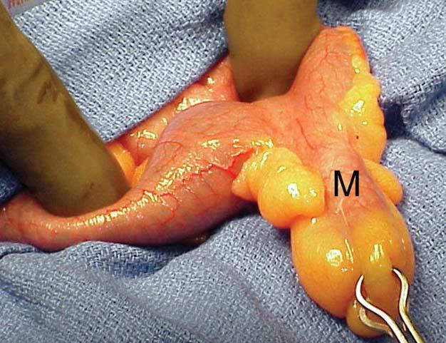 Anatomy of Meckel s Blind sac ANTI-mesenteric Usually within 40-100 cm of ileocecal valve True diverticulum Normal: 5 cm length, 2 cm