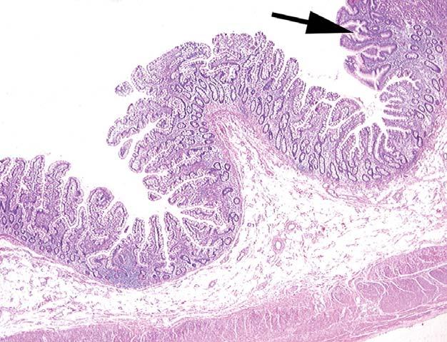 Gastric mucosa Heterotopic tissue 60% of symptomatic pts Pancreatic tissue 6% of symptomatic pts Combined gastric and pancreatic Other (jejunal, duodenal, etc.