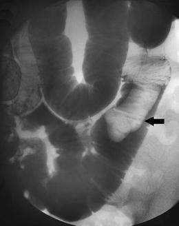An unusual cause of intermittent abdominal pain (2006: 5b).