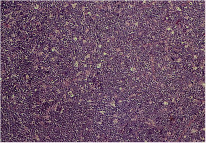 Figure 2: Histopathological appearance of Burkitt s lymphoma Figure 3: Lymphoma cells arranged in diffuse sheets admixed with numerous macrophages giving a starry sky pattern (H&E, x100) Figure 4: