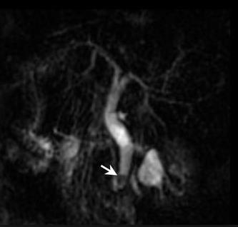 MRCP showing stone in lower part of MRCP image shows a