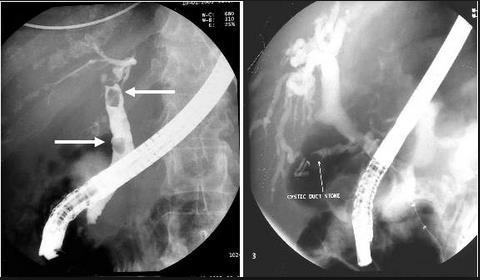 These two fluorospot images taken during an ERCP demonstrates stones in the
