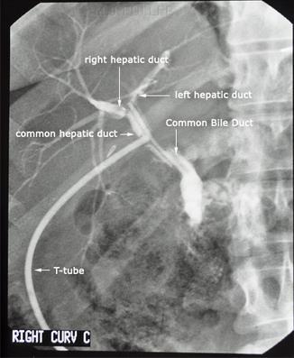 T-tube cholangiograms T-tube