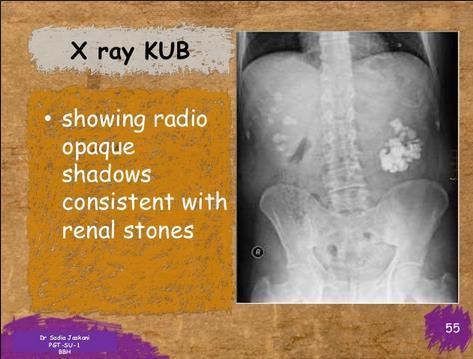 XRAY KUB showing radio-opaque