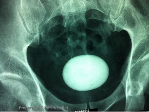 XRAY KUB showing bladder stone A plain KUB showing a large