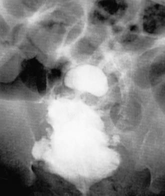 Ascending cystography showing urinary bladder diverticuli A
