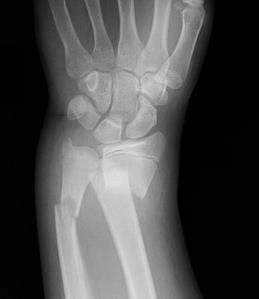 Xray showing the fracture