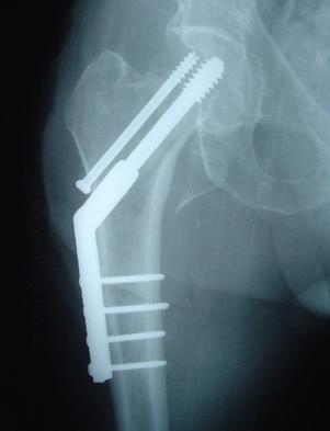 Xray showing dynamic hip screw transfixing