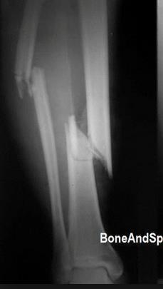 Xray showing fracture of