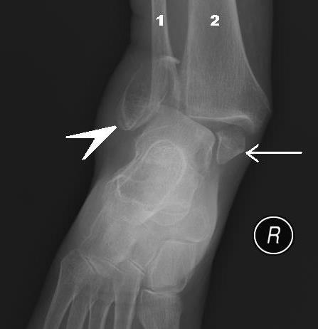 Xray showing bi-malleolar fracture (pott fracture) with distortion of ankle joint Bimalleolar fracture and right ankle dislocation on X-ray (anteroposterior).