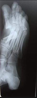 Xray showing fracture of 1 st metatarsal bone Preoperative radiographs showing the