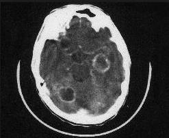 CT Scan showing