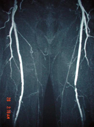 This magnetic resonance angiogram (MRA) of the lower extremities was obtained by using the bolus-chase technique.