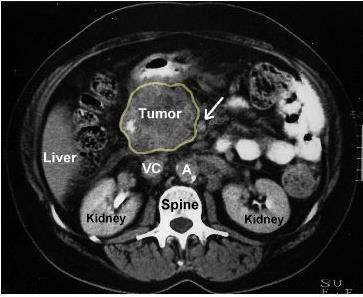 CT scan showing tumor in head of pancreas The