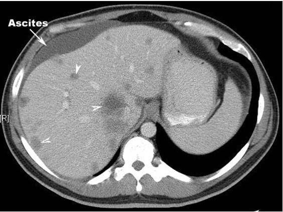 Liver metastasis Multiple hypodense lesions seen in