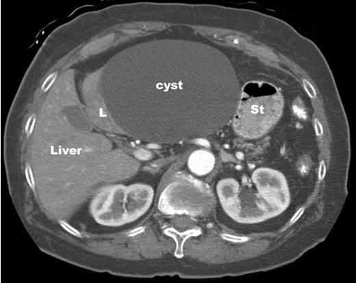 LIVER CYST Oval, well defined