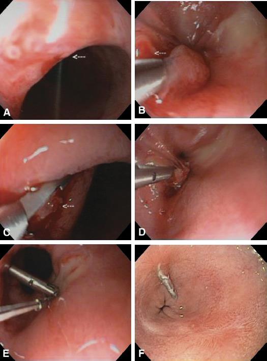 Endoclip Treatment Through-the-scope Quick > Resolution > Instinct Use what you are used to Clip Meta-analysis (Sung et al.