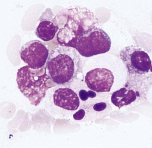 Limitations 23 Figure 3.2 Note the prominent apoptosis of cells (likely blasts) within this old marrow specimen.
