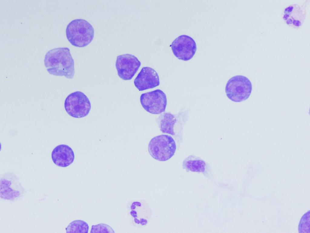 CSF: History of diffuse large B-cell lymphoma