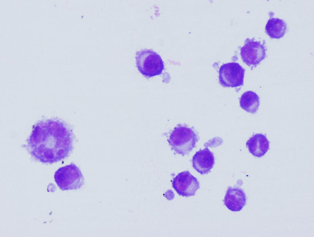 CSF: History of plasma cell myeloma,