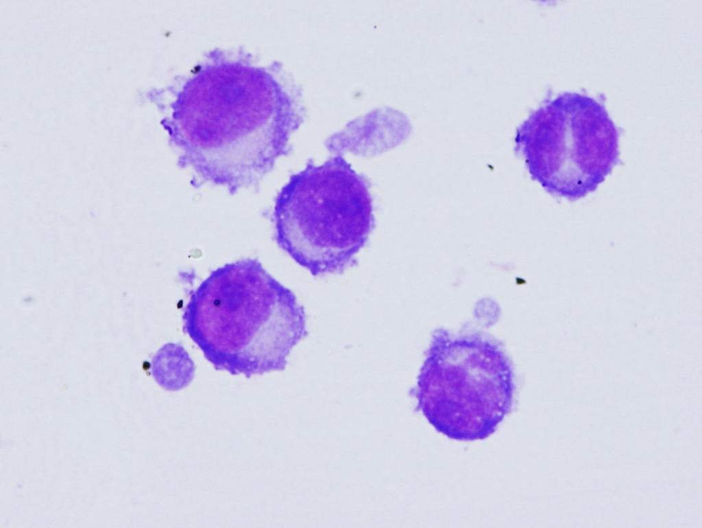 CSF: History of plasma cell myeloma,
