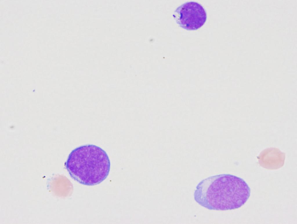 CSF: Recent diagnosis of high grade B-cell lymphoma