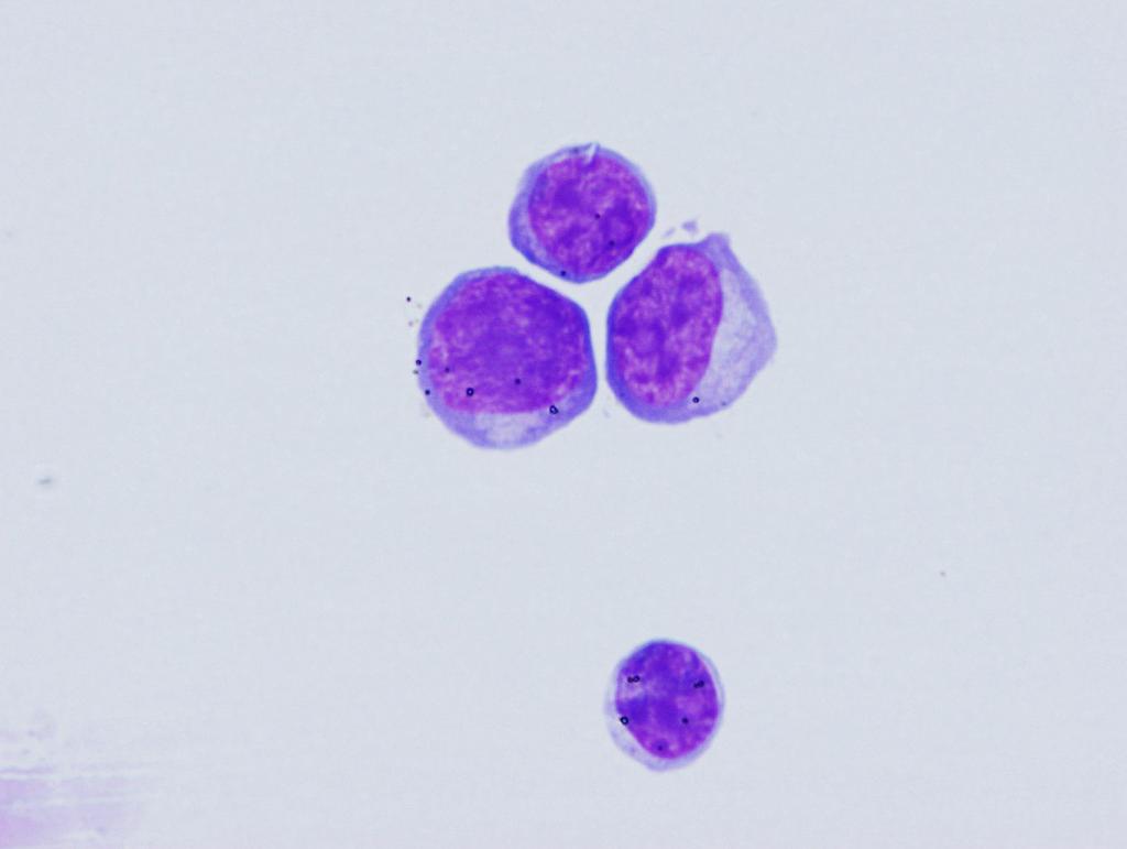 CSF: Previous diagnosis high grade B-cell lymphoma,