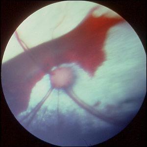 The Red Eye Retinal Hemorrhage Blood in the Back Eye Blood in back of eye in the posterior chamber Causes include