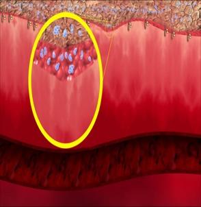 Microbiology of the Skin 80% of the resident bacteria exist within first 5 layers of stratum corneum.