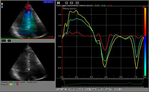 7th Annual Team Echocardiography: The Heart of Cardiovascular Medicine Tissue Doppler, Strain, Speckle: What? How?