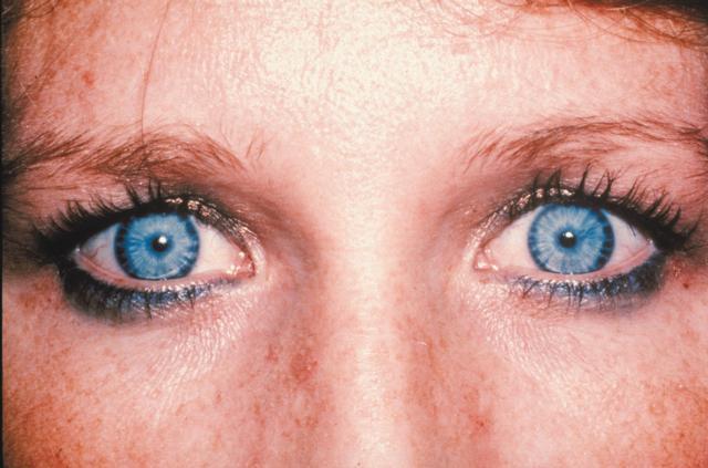Eyes Constricted pupils (Miosis) is a classic sign of exposure Along