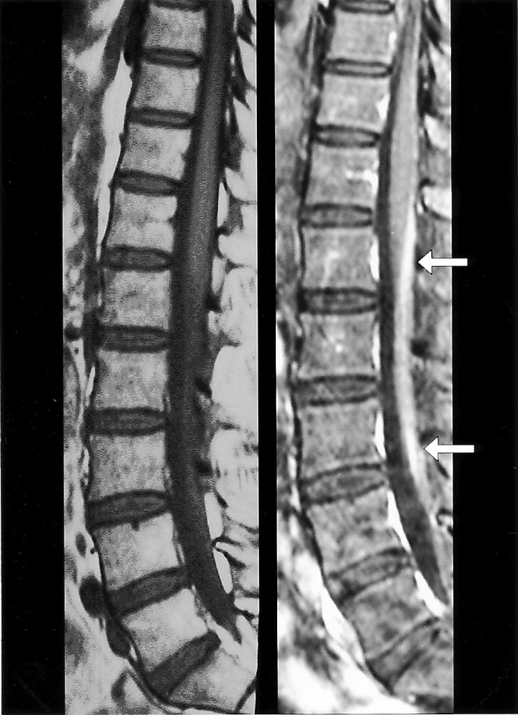 62 Kobayashi T Shiraishi M et al cold medicine. The numbness of the lower limbs persisted, and 4 days later, the patient started to have di$culties in walking because of the pain.