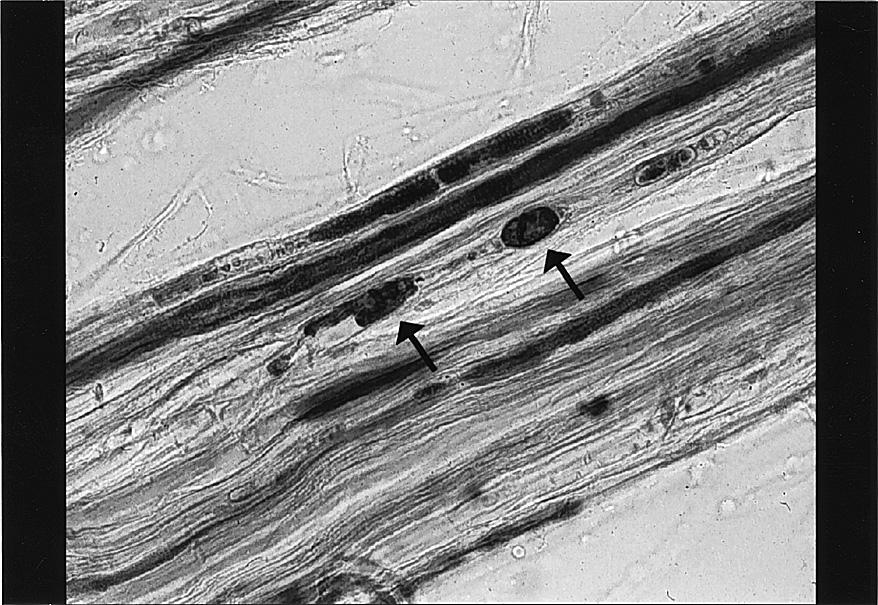 b, Teased-fibers by Osmium staining 100 revealed many myelin spherules along the length of the fibers.