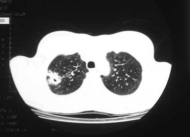 Tuberculosis I Lung