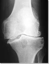 Importance Cartilage Pathology Musculoskeletal conditions are the most common causes of severe long-term pain and