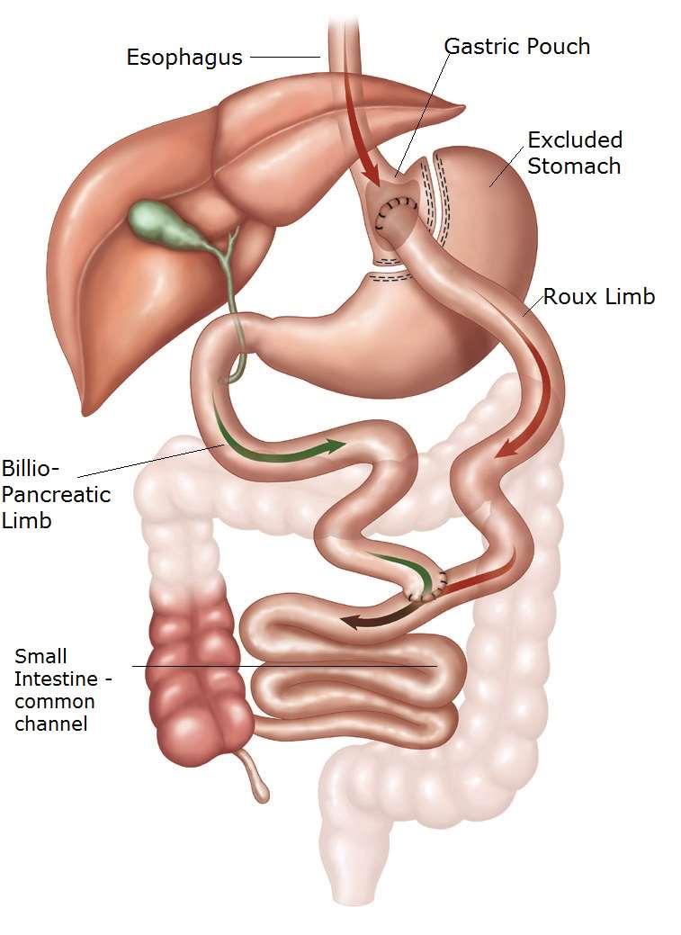 Combination Procedures Roux-en-Y Gastric Bypass A small proximal pouch is created out of the larger stomach Gastric pouch is