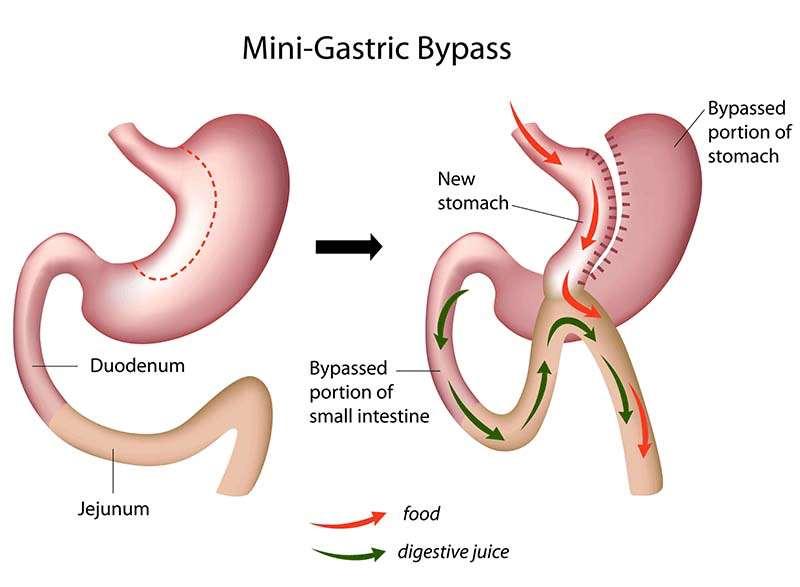 Combination Procedures Mini-Gastric Bypass Much larger stomach pouch is created similar to sleeve