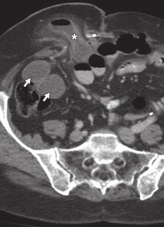 , xial contrast-enhanced CT image shows left lower quadrant end colostomy (arrow). Fig. 5 Loop ostomy.