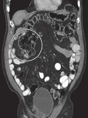 C, Coronal contrast-enhanced CT image shows right upper quadrant anastomosis (circle).