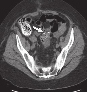 , xial contrast-enhanced CT image shows remainder of rectal stump (arrow) as it passes