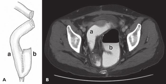 Roberts et al. Fig. 13 Ileal pouch anal anastomosis., Diagram shows J-shaped pelvic pouch reservoir made from afferent (a) and blind (b) limb of small bowel.