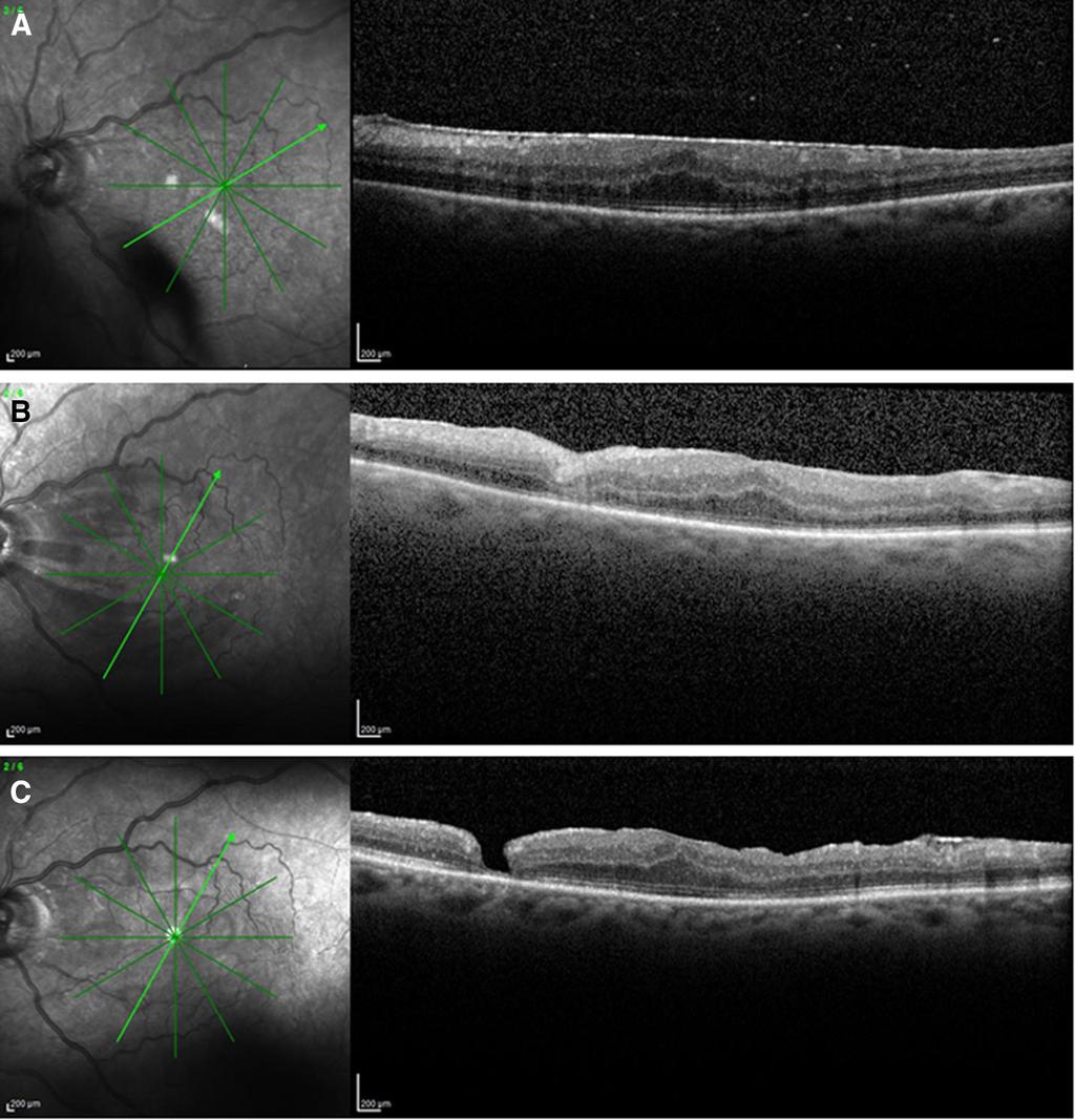 Ophthalmol Ther (2017) 6:391 395 393 Fig. 1 a B-scan optical coherence tomography (OCT), showing the epiretinal membrane (ERM) at baseline.