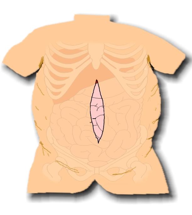 Open or Traditional Surgery A 10- to 15-inch incision is made so that the surgeon