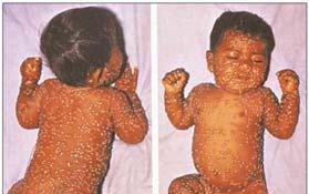 Variolation Smallpox Late 1790 s Edward Jenner developed a vaccine 1967 WHO proposed eradication 1977 last naturally occurring case occurred in Somalia 1980 declared eradicated Smallpox New York