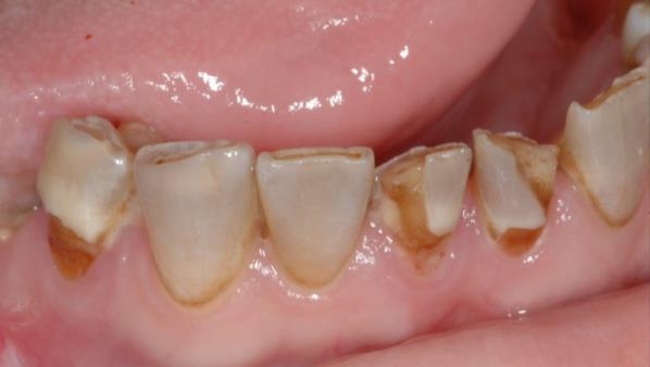 dentition breakdown with radiation Shear fracture of enamel