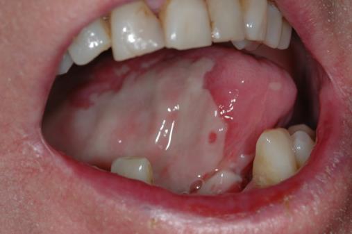 Mucositis Common morbidity Oral mucosa sensitive to XRT Severity