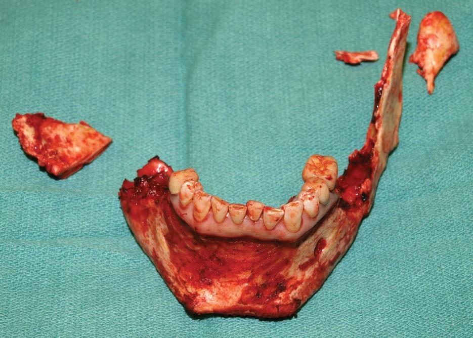 Osteoradionecrosis Total mandibulectomy with fibula