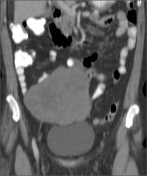 Coronal CECT image shows the left ovarian large mass, predominantly solid and heterogeneous, with small areas of