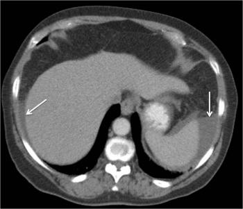 Imaging Technique: CT; Axial CECT image demonstrates the coexistence of